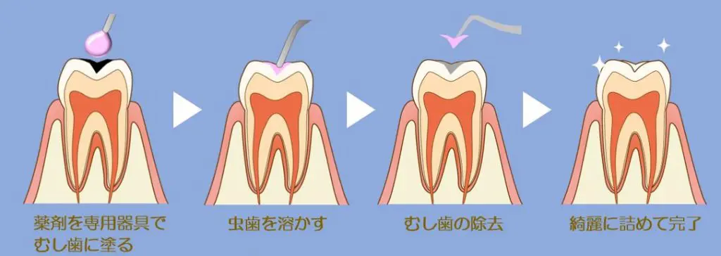 虫歯以外のところは削らないでほしい ドリルの音を聞くと怖くなる そんなあなたに削らない虫歯治療 医療法人社団優志会 ヒロ デンタルクリニック