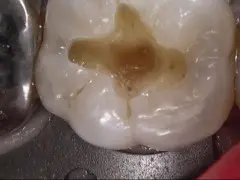 神経近くまで及ぶ深い虫歯を取ったあと