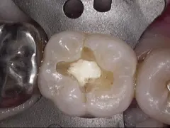MTAセメントを使用した治療