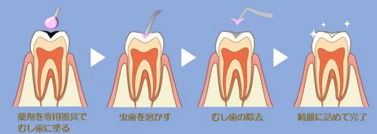 カリエスプロ治療（カリソルブ治療）