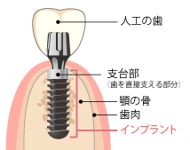 インプラント