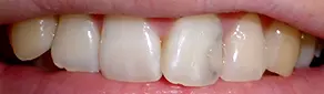 審美歯科症例前