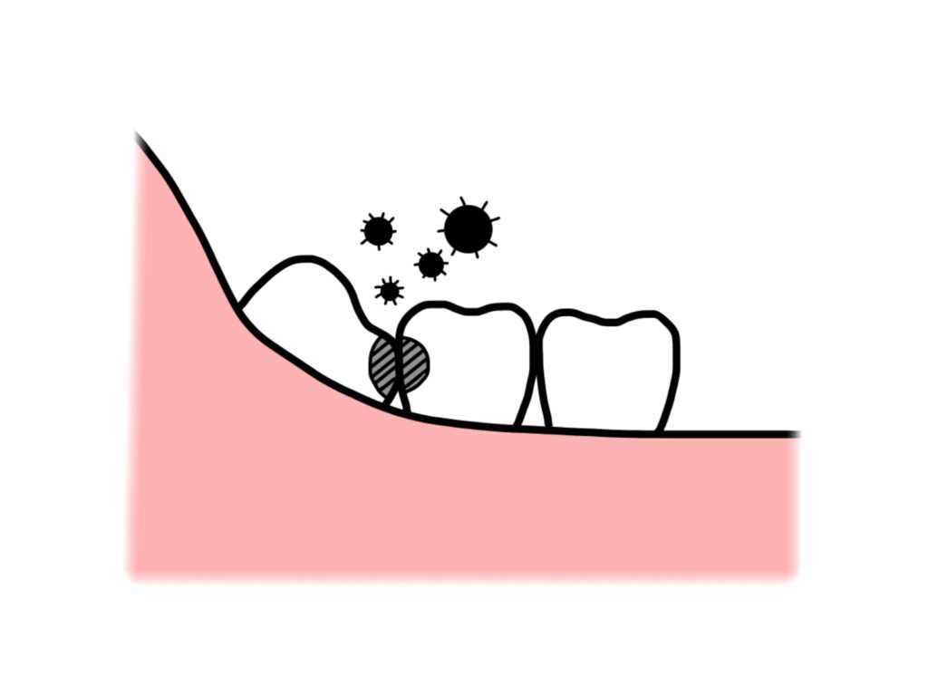 親知らずの虫歯